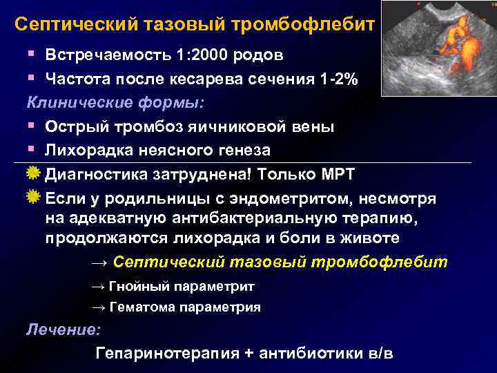 Септический тазовый тромбофлебит § Встречаемость 1: 2000 родов § Частота после кесарева сечения 1