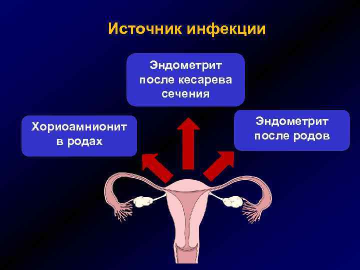 Источник инфекции Эндометрит после кесарева сечения Хориоамнионит в родах Эндометрит после родов 