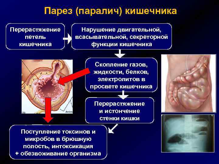 Нарушение моторной функции кишечника