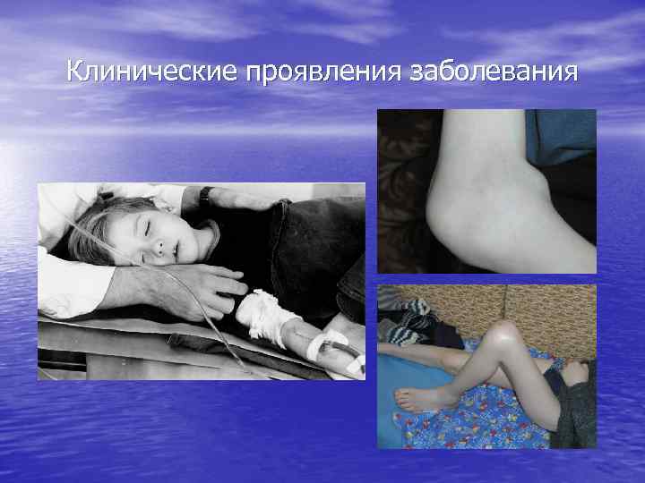 Клинические проявления заболевания 
