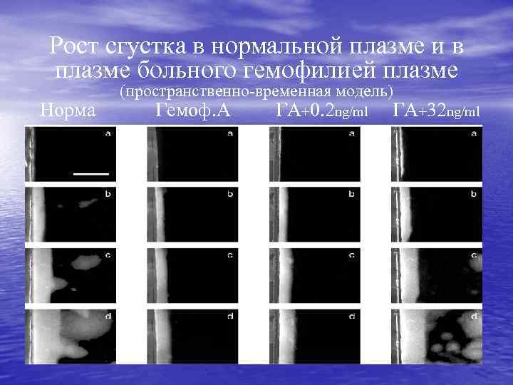 Рост сгустка в нормальной плазме и в плазме больного гемофилией плазме Норма (пространственно-временная модель)