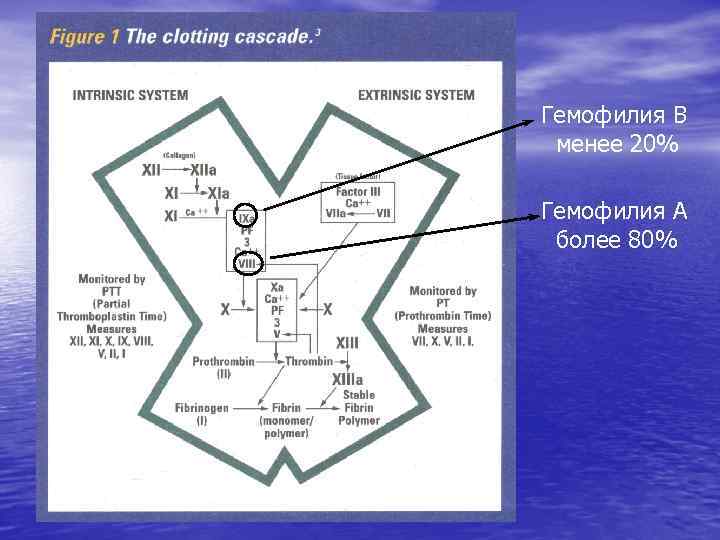 Гемофилия В менее 20% Гемофилия А более 80% 