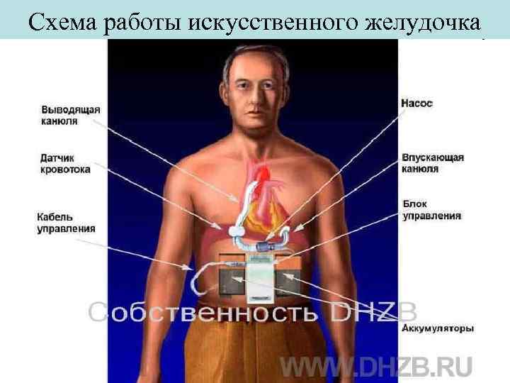 Схема работы искусственного желудочка 