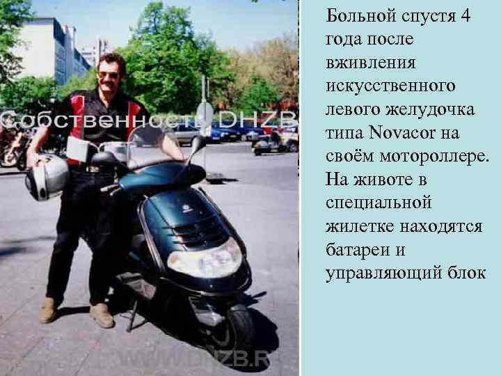  Больной спустя 4 года после вживления искусственного левого желудочка типа Novacor на своём