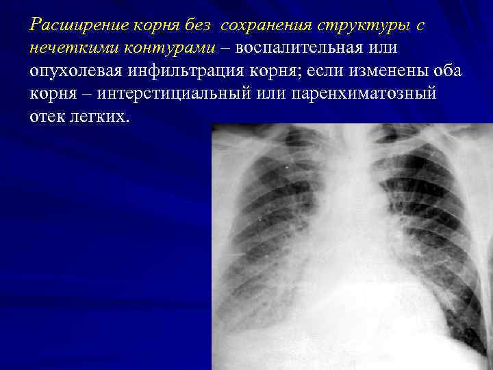 Рентгенологическая картина отека легких