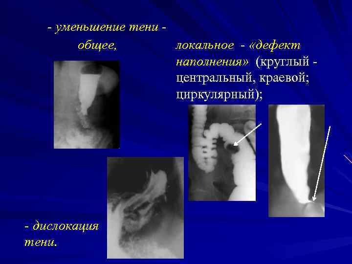 - уменьшение тени общее, локальное - «дефект наполнения» (круглый центральный, краевой; циркулярный); - дислокация