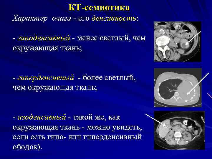 КТ-семиотика Характер очага - его денсивность: - гиподенсивный - менее светлый, чем окружающая ткань;