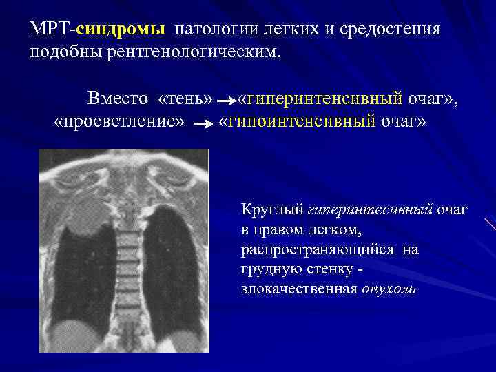 МРТ-синдромы патологии легких и средостения подобны рентгенологическим. Вместо «тень» «гиперинтенсивный очаг» , «просветление» «гипоинтенсивный