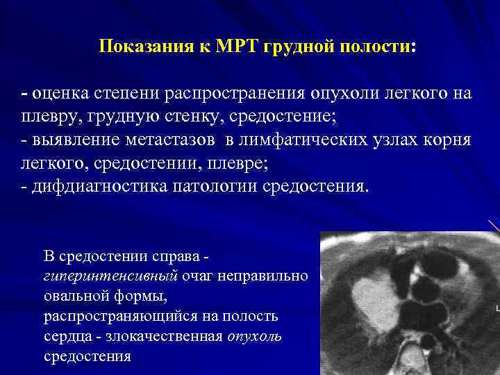 Показания к МРТ грудной полости: - оценка степени распространения опухоли легкого на плевру, грудную