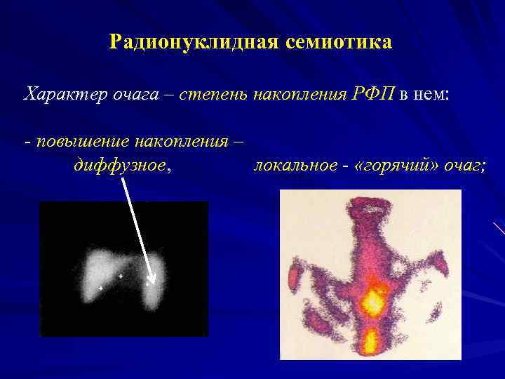 Радионуклидная семиотика Характер очага – степень накопления РФП в нем: - повышение накопления –