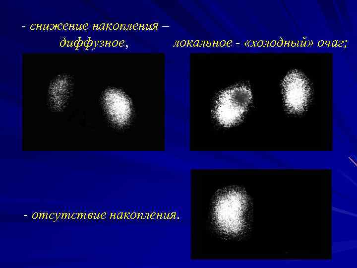 - снижение накопления – диффузное, локальное - «холодный» очаг; - отсутствие накопления. 