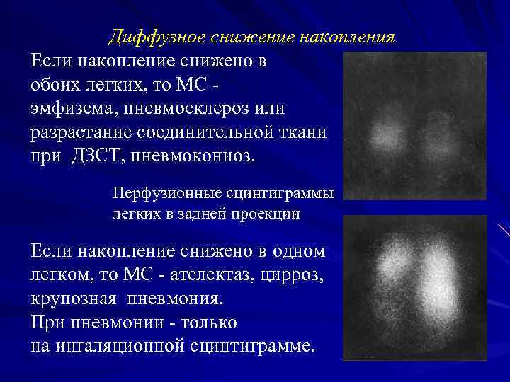 Диффузное снижение накопления Если накопление снижено в обоих легких, то МС эмфизема, пневмосклероз или