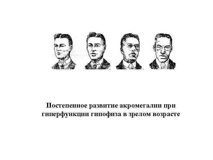 Постепенное развитие акромегалии при гиперфункции гипофиза в зрелом возрасте 