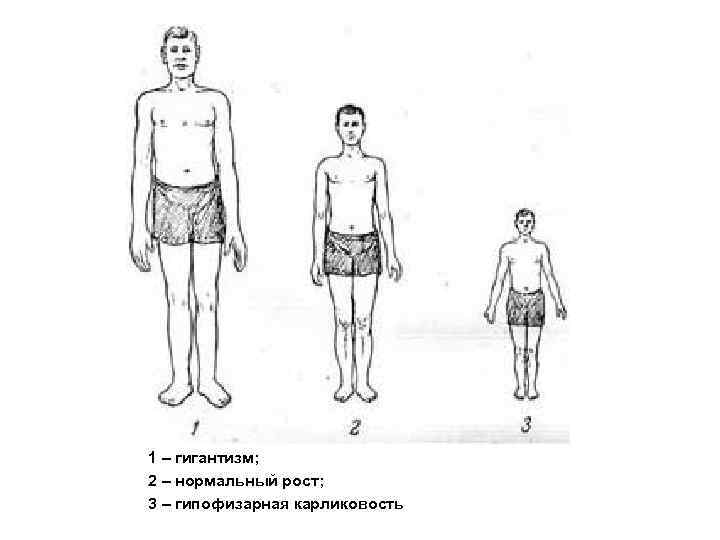 Гигантизм клиническая картина