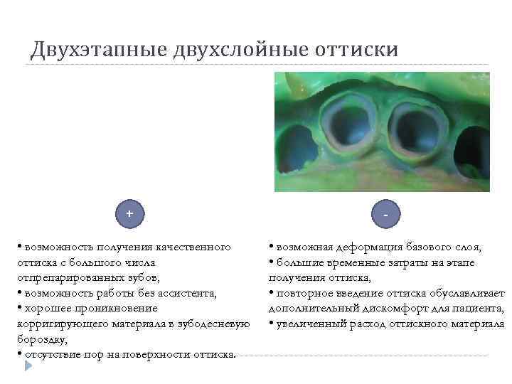 Двухэтапные двухслойные оттиски + • возможность получения качественного оттиска с большого числа отпрепарированных зубов,
