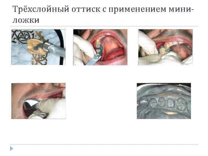 Снятие оттиска индивидуальной ложкой под псп