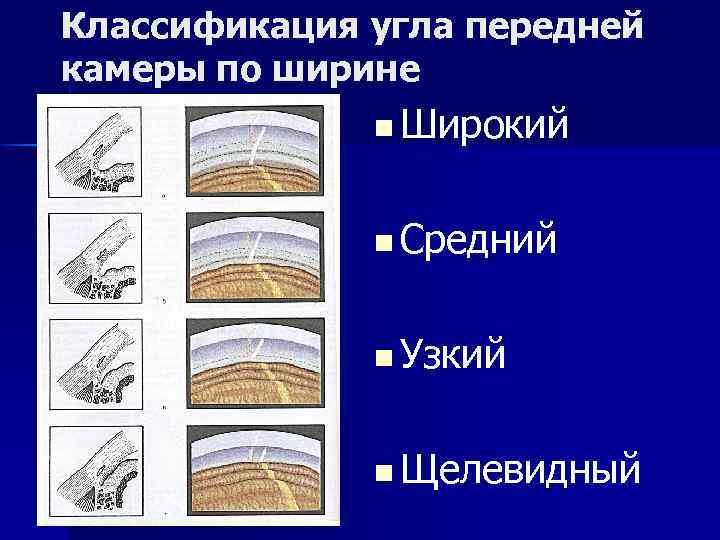 Классификация угла передней камеры по ширине n Широкий n Средний n Узкий n Щелевидный