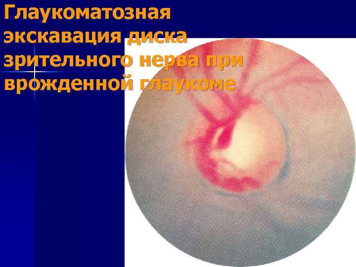 Глаукоматозная экскавация диска зрительного нерва при врожденной глаукоме 