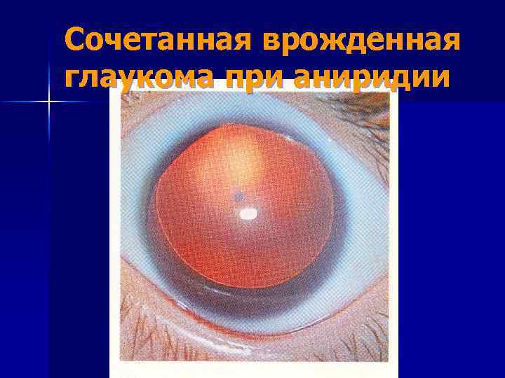 Сочетанная врожденная глаукома при аниридии 