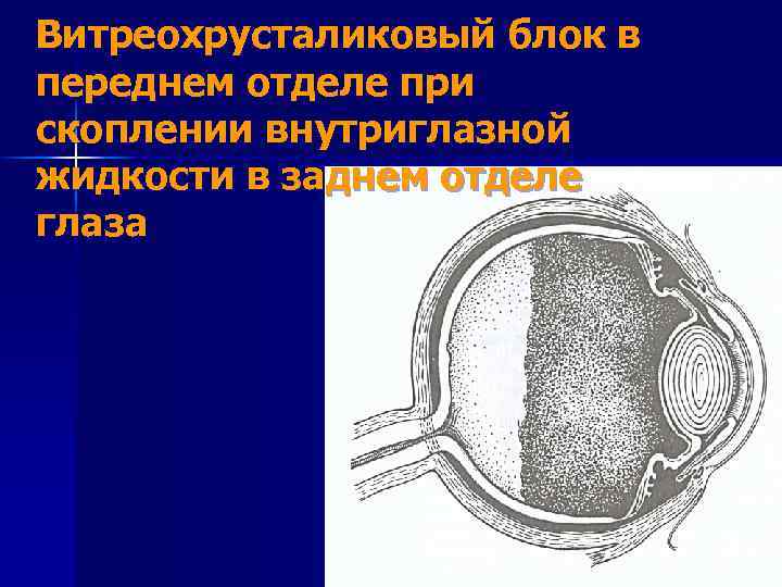 Витреохрусталиковый блок в переднем отделе при скоплении внутриглазной жидкости в заднем отделе глаза 