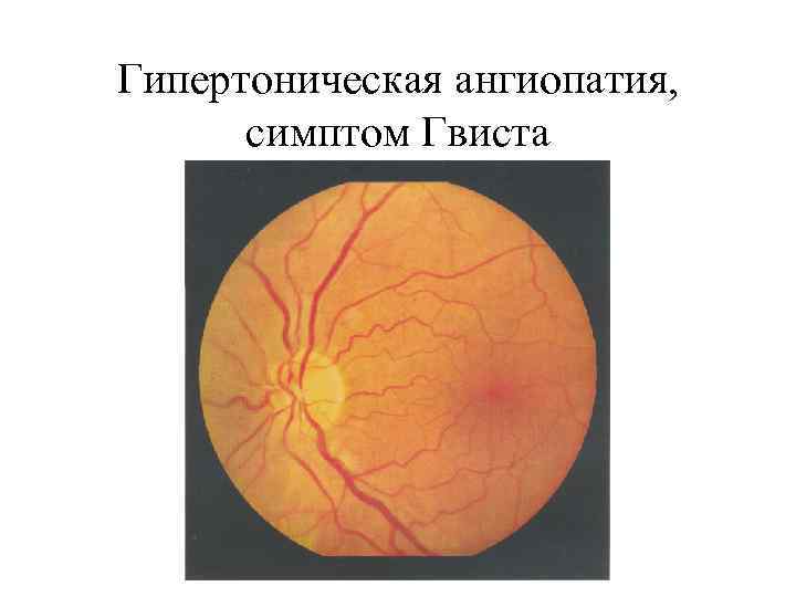 Гипертоническая ангиопатия обоих глаз. Гипертоническая ангиопатия глаза. Ангиопатия сетчатки глаза. Ангиопатия сетчатки глазное дно. Гипертоническая ангиопатия сосудов.