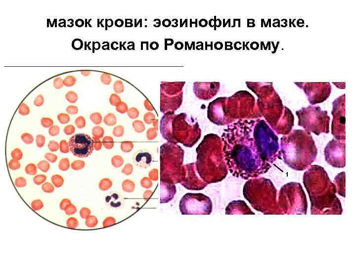 мазок крови: эозинофил в мазке. Окраска по Романовскому. 1 2 3 4 5 