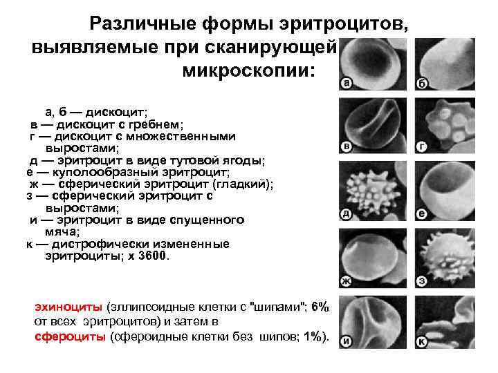 Различные формы эритроцитов, выявляемые при сканирующей электронной микроскопии: а, б — дискоцит; в —