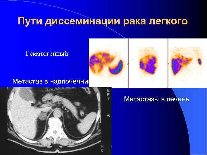 Пути диссеминации рака легкого Гематогенный Метастаз в надпочечник Метастазы в печень 