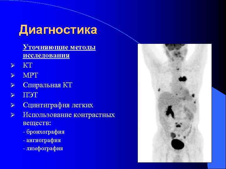 Диагностика Ø Ø Ø Уточняющие методы исследования КТ МРТ Спиральная КТ ПЭТ Сцинтиграфия легких