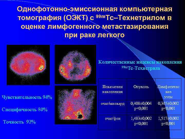 Однофотонно-эмиссионная компьютерная томография (ОЭКТ) с 99 m. Тс–Технетрилом в оценке лимфогенного метастазирования при раке