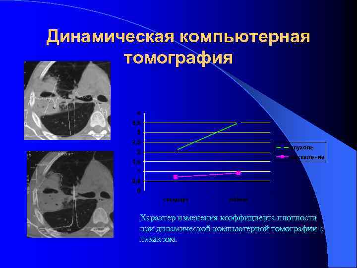 Динамическая компьютерная томография Характер изменения коэффициента плотности при динамической компьютерной томографии с лазиксом. 