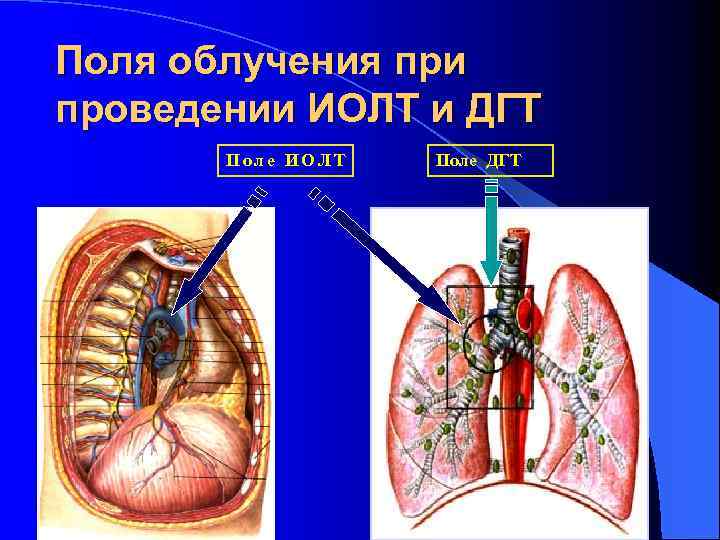 Поля облучения при проведении ИОЛТ и ДГТ Поле ИОЛТ Поле ДГТ 
