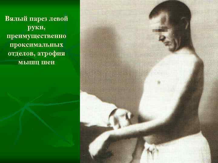 Вялый парез левой руки, преимущественно проксимальных отделов, атрофия мышц шеи 