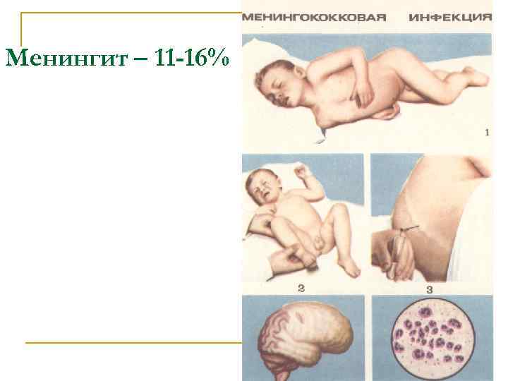 Менингит – 11 -16% 