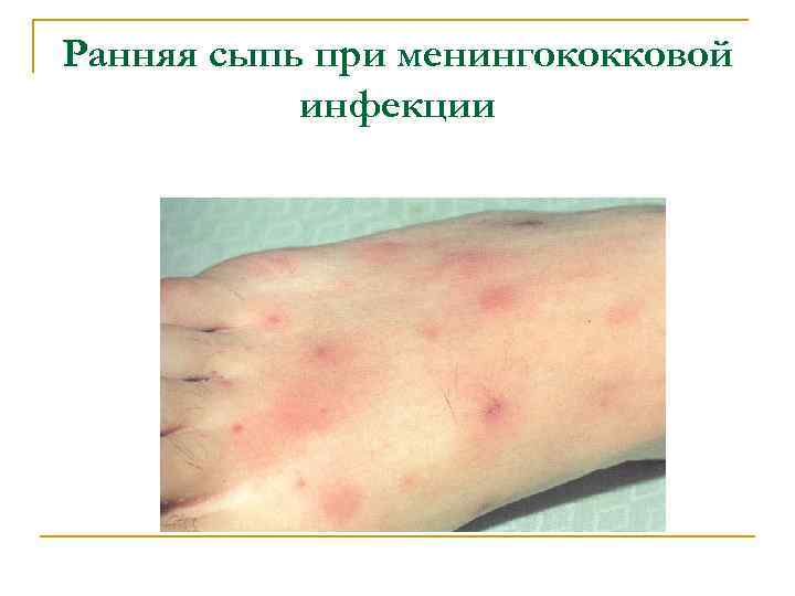 Ранняя сыпь при менингококковой инфекции 