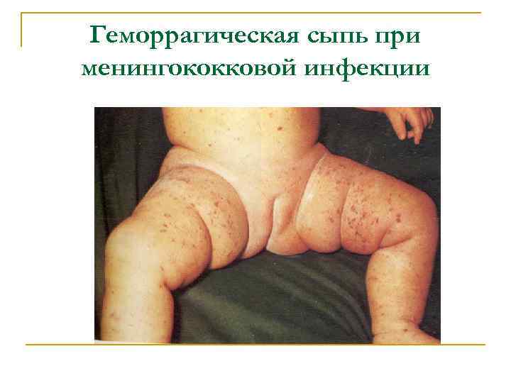 Геморрагическая сыпь при менингококковой инфекции 