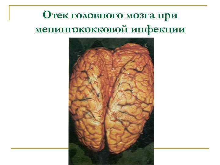Отек головного мозга при менингококковой инфекции 