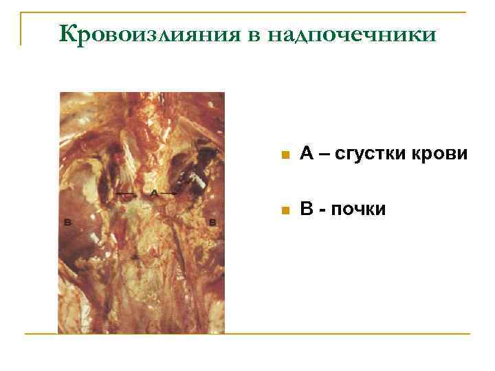 Кровоизлияния в надпочечники n А – сгустки крови n В - почки 