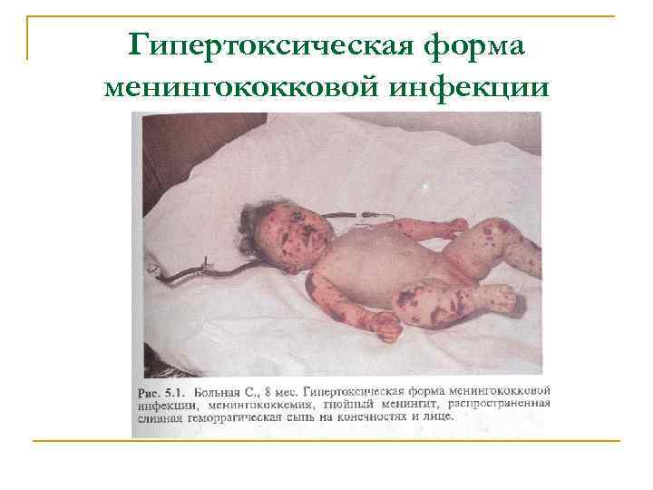 Гипертоксическая форма менингококковой инфекции 