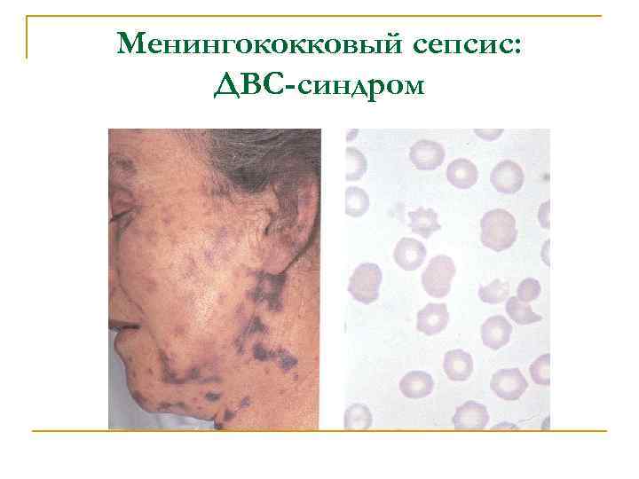 Менингококковый сепсис: ДВС-синдром 