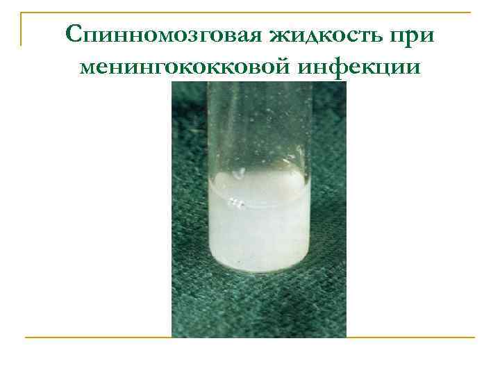 Спинномозговая жидкость при менингококковой инфекции 