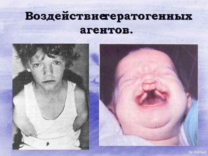 Воздействие тератогенных агентов. By OLEGarh 