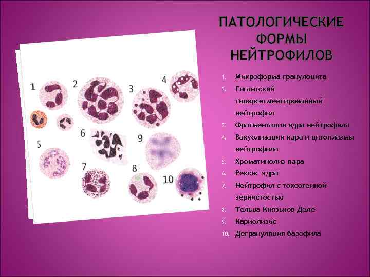 ПАТОЛОГИЧЕСКИЕ ФОРМЫ НЕЙТРОФИЛОВ 1. Микроформа гранулоцита 2. Гигантский гиперсегментированный нейтрофил 3. Фрагментация ядра нейтрофила