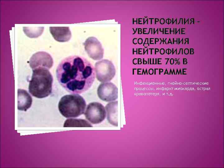 НЕЙТРОФИЛИЯ – УВЕЛИЧЕНИЕ СОДЕРЖАНИЯ НЕЙТРОФИЛОВ СВЫШЕ 70% В ГЕМОГРАММЕ Инфекционные, гнойно-септические процессы, инфаркт миокарда,