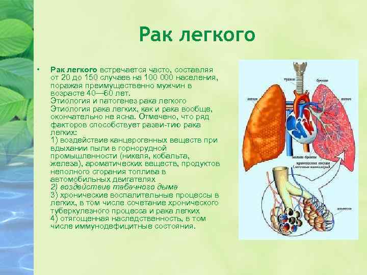 Причины возникновения рака легких