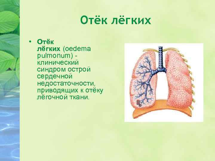 Отёк лёгких • Отёк лёгких (oedema pulmonum) клинический синдром острой сердечной недостаточности, приводящих к