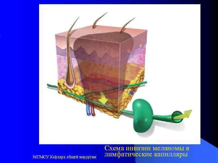 МГМСУ Кафедра общей хирургии Cхема инвазии меланомы в лимфатические капилляры 
