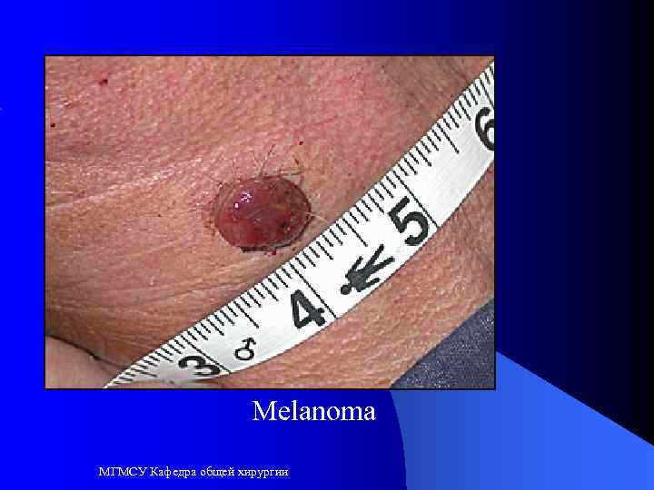 Melanoma МГМСУ Кафедра общей хирургии 