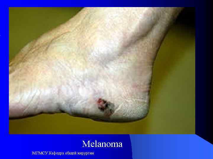 Melanoma МГМСУ Кафедра общей хирургии 