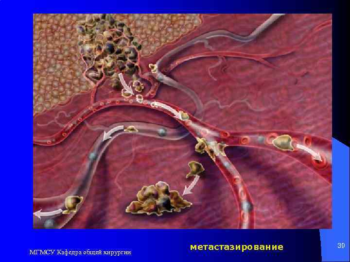 МГМСУ Кафедра общей хирургии метастазирование 39 